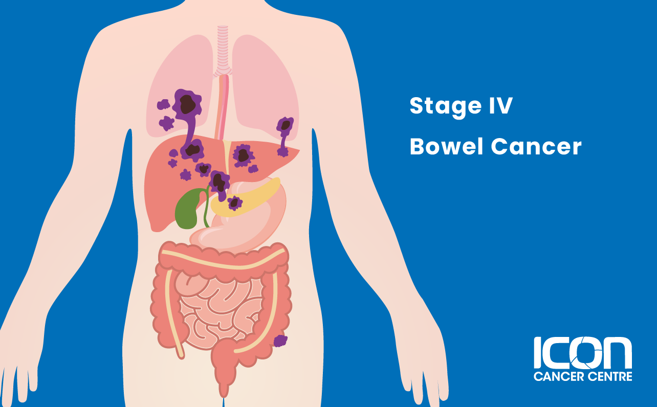 Stage IV bowel cancer illustration