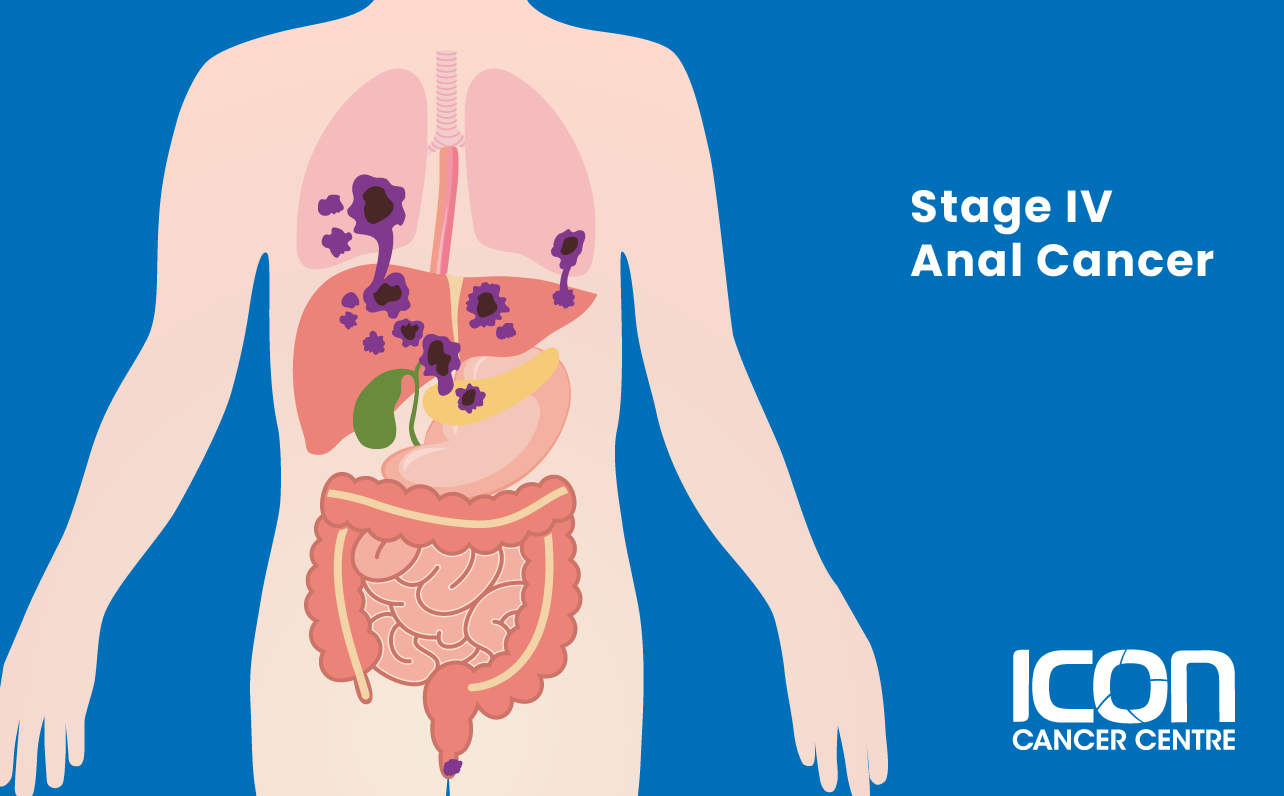 Stage IV anal cancer illustration