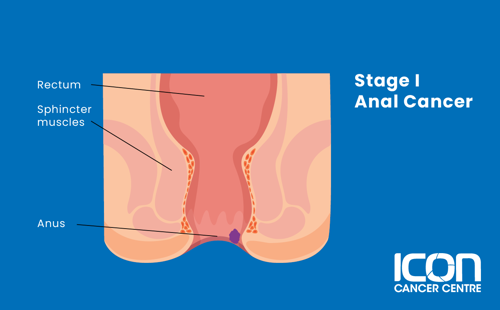 Stage I anal cancer illustration