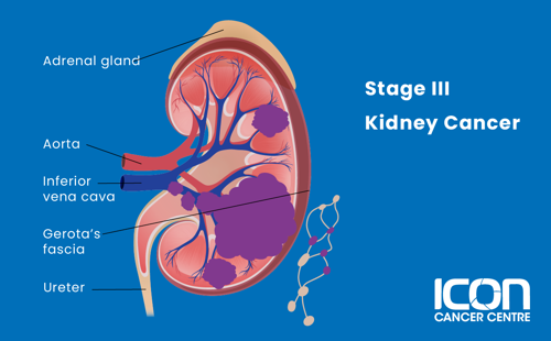 Stage III kidney cancer illustration