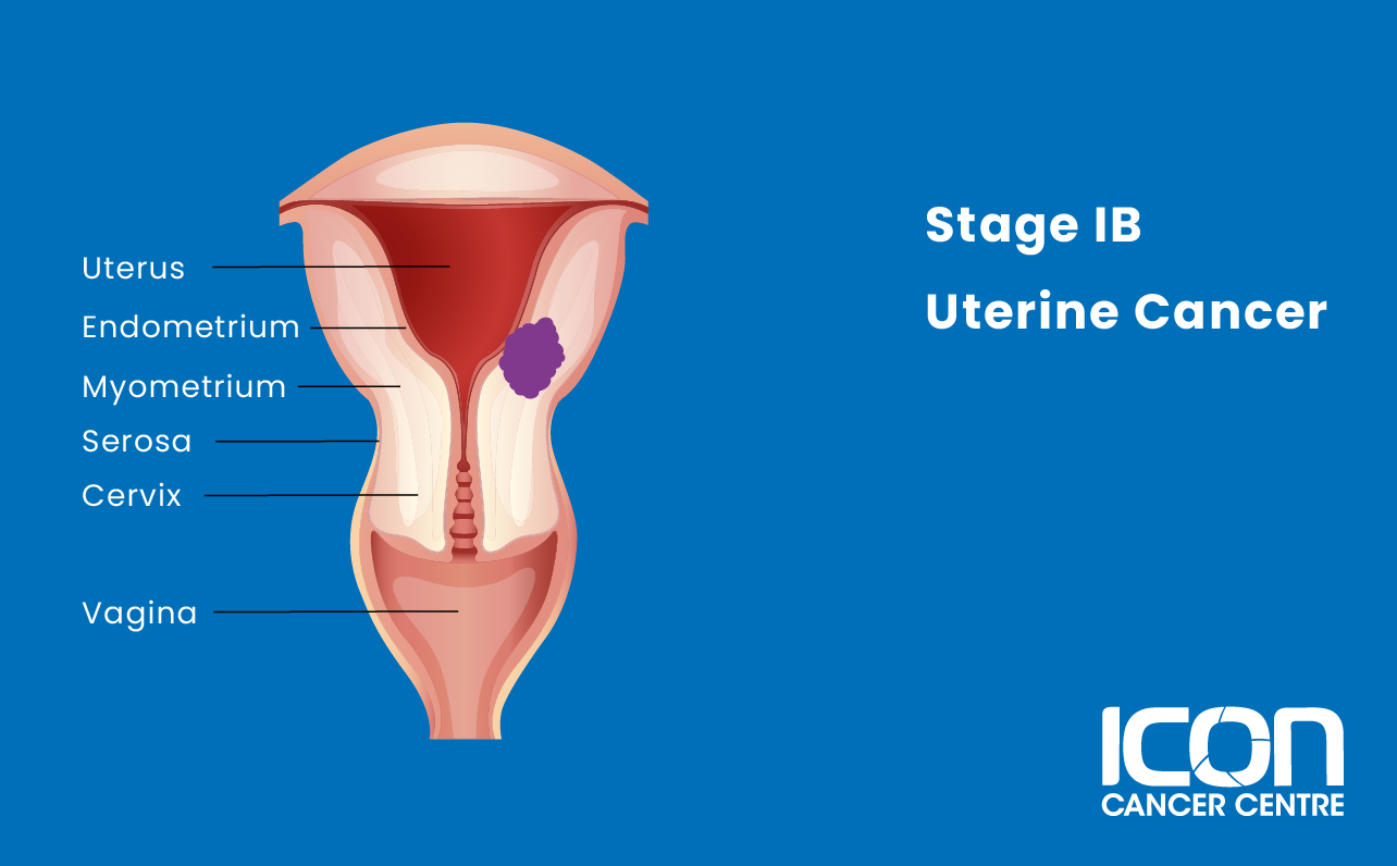 Stage IB uterine cancer illustration