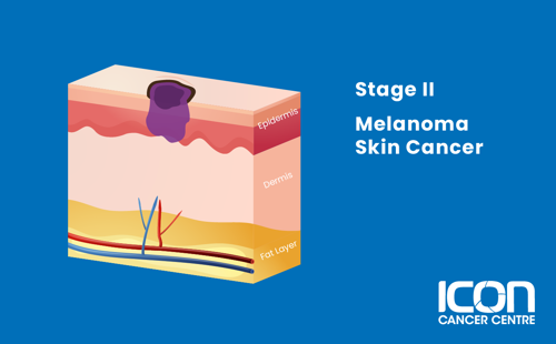 Stage II melanoma illustration