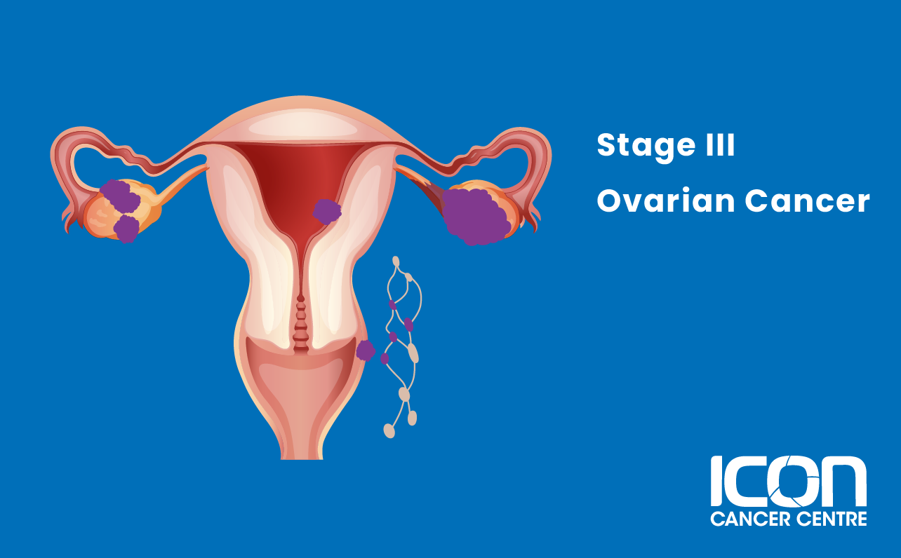 Stage III ovarian cancer illustration